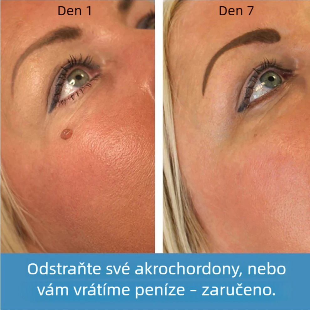 MyPokožka™ – Sbohem kožním výrůstkům!