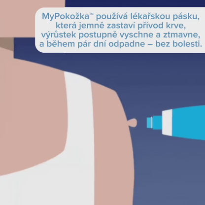MyPokožka™ – Sbohem kožním výrůstkům!